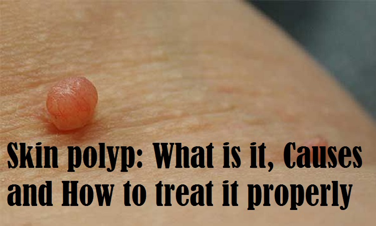 Skin polyp: What is it, Causes and How to treat it properly