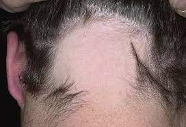 How to Cope With Alopecia Areata